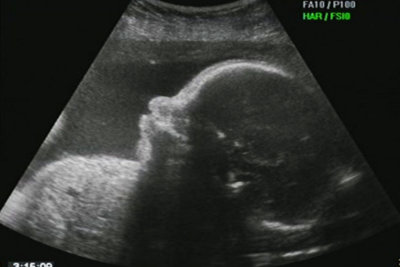 Fetal Echocardiogram